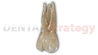 Aged maxillary second molar (2)